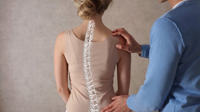 Сколиозата не е за подценяване. Снимка: istock.