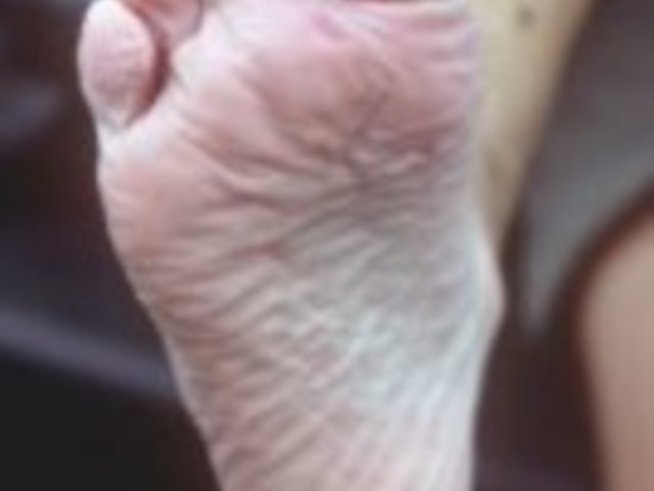 За борба с гъбичките