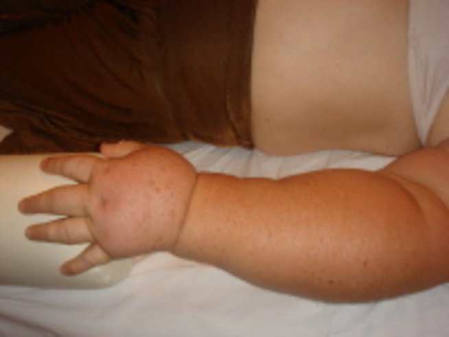 Лимфедемът вече е лечимо състояние