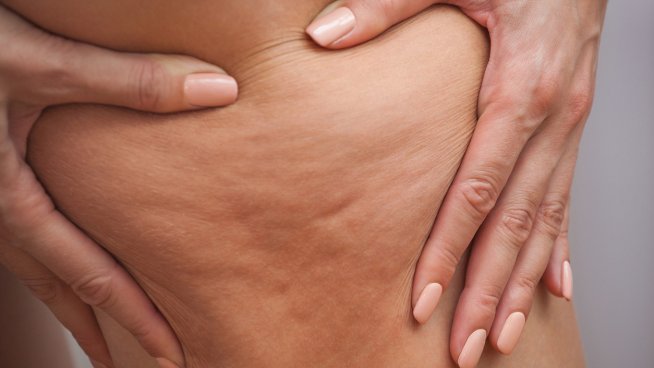 9 мощни храни срещу целулит. Снимка: istock