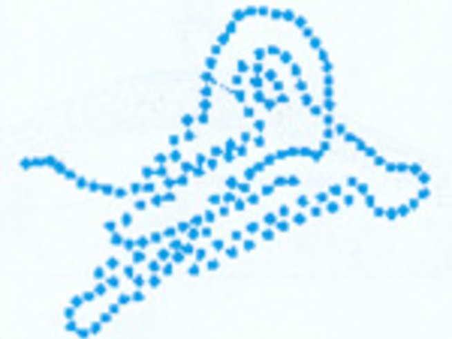 Над 3500 са заболелите от множествена склероза