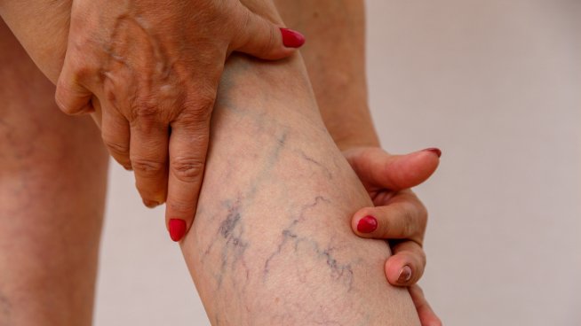 5 изпитани средства да си помогнем при разширени вени. Снимка: istock