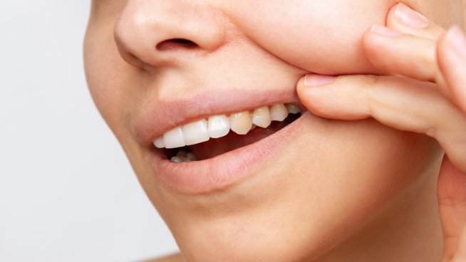 Хитри начини да се предпазите от зъбен камък. Снимка: istock