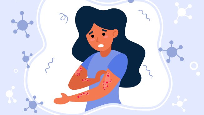 Полезни и забранени храни при екзема.Снимка: istock