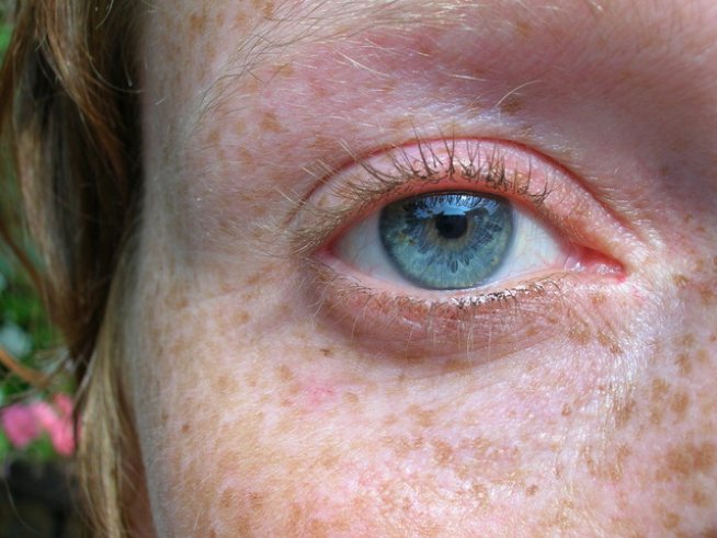 Лунички по лицето. Снимка: Sxc.hu