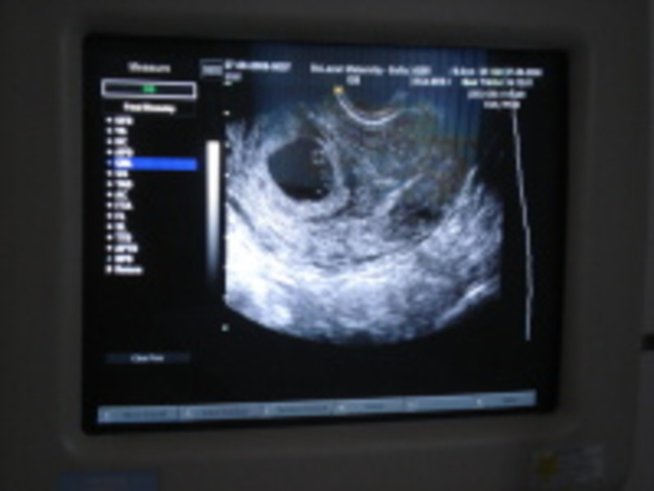 Пренатална диагностика