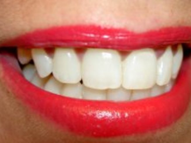 Какво представлява избелването на зъби? Видове избелвания