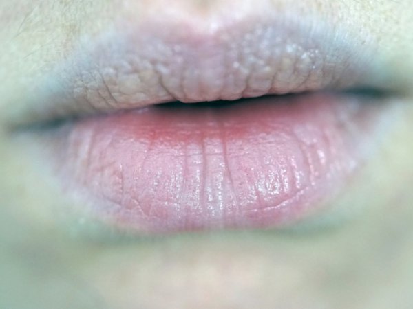 Бледи устни
Бледите устни може да са знак, че ви липсва желязо. Ниското артериално налягане и честите настинки могат да бъдат допълнителни признаци за този дефицит. Възстановяването на нивата на желязо е трудно. Въпреки това хапвайте повече червено месо, черен дроб, сусамово семе, кайсии, цитруси, пресни зеленчуци. Витамин С е много важен за усвояването на желязото от храната, която консумираме. В същото време е добре да внимавате с приема на калциеви добавки и храни богати на този минерал, тъй като те могат да нарушат това усвояване. Опитайте се да създадете баланс в храненето, така че да не се лишавате и от млечни продукти.&nbsp;&nbsp;снимка: istock